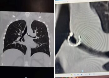 Empezó a toser y un mes después descubrió un objeto insólito en sus pulmones
