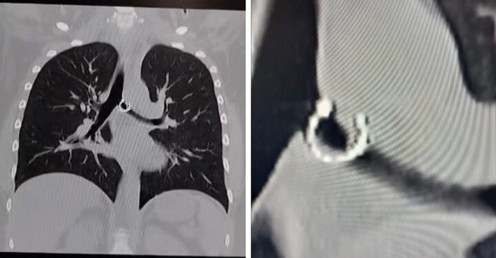 Empezó a toser y un mes después descubrió un objeto insólito en sus pulmones
